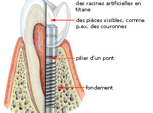 Dentiste Parmentier - implant dentaire