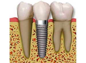 Dentiste Parmentier - implant dentaire