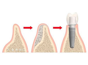 Dentiste Parmentier - implant dentaire