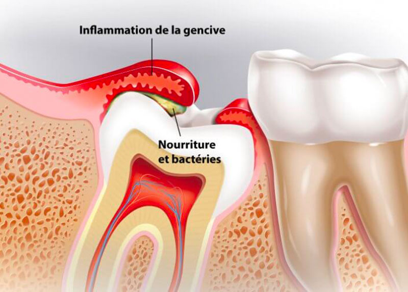 Dentiste Parmentier - dents de sagesse